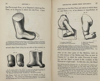 ON THE NATURE, CAUSES, VARIETY, AND TREATMENT OF BODILY DEFORMITIES: in a Series of Lectures Delivered at the City Orthopædic Hospital in the Year 1852, and Subsequently
